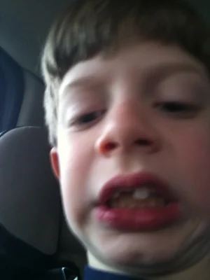 alexs-tooth-broke-2.webp