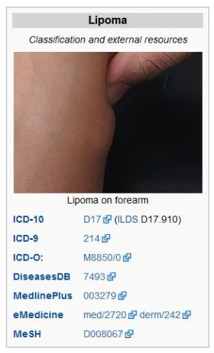 wikipedia.lipoma.ICD10.structured.data.webp